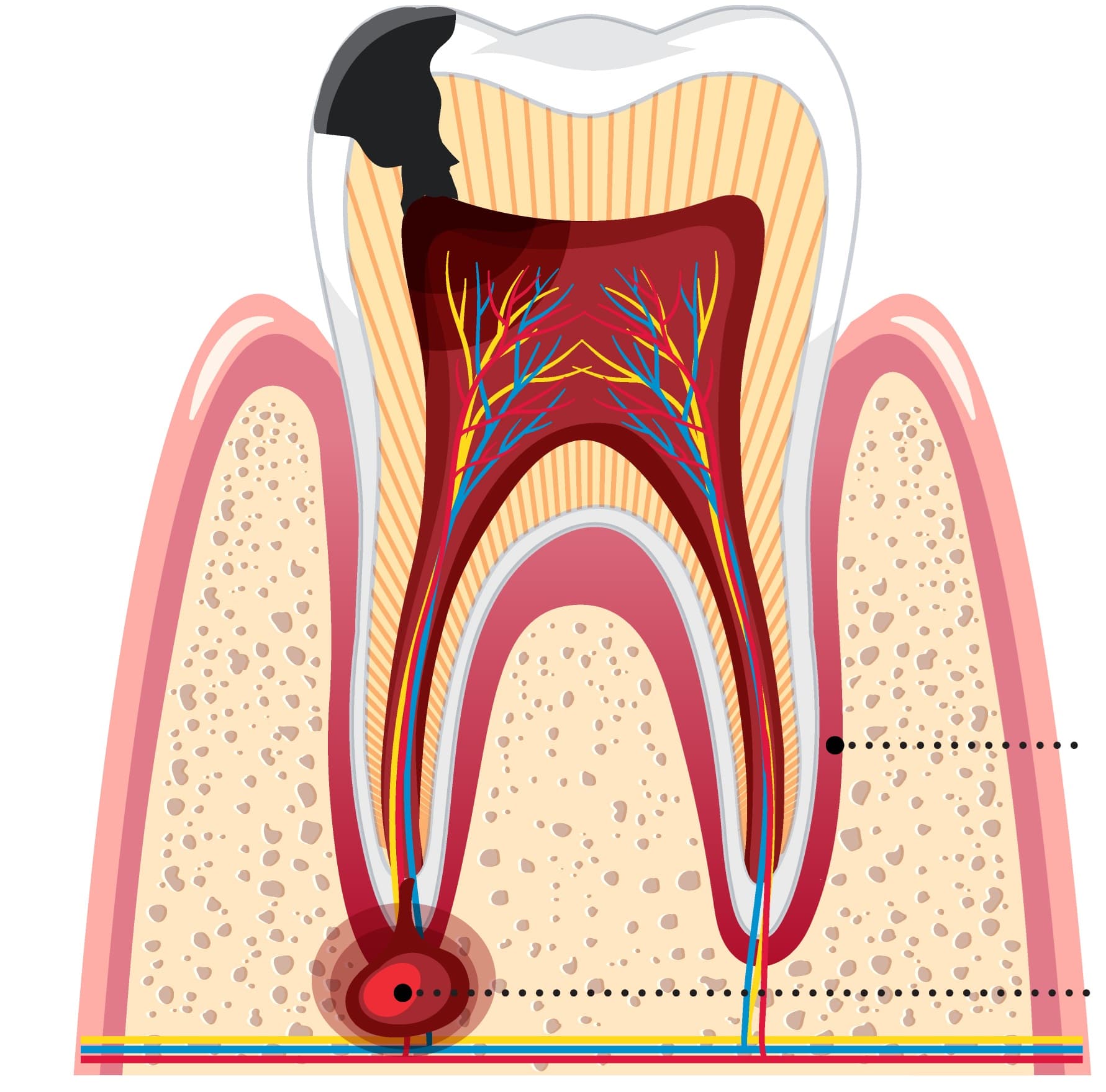 Carie cu afectare pulpară și granulom — tratament endodontic