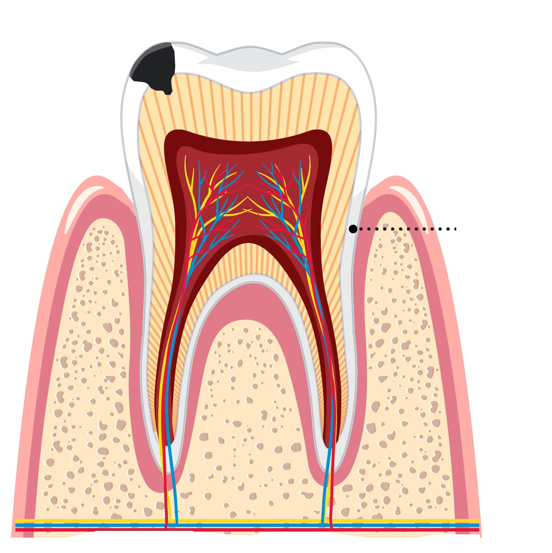 Carie simplă fără afectare pulpară — obturație dentară